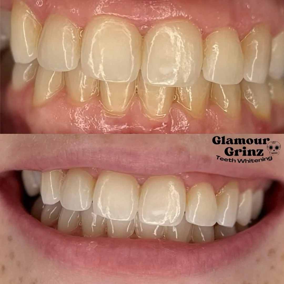 before &amp; after 2nd session ❕⭐️
She was so happy with her results 😊

Booking in bio | DM 🩵

#greenbay #teethwhitening #beforeandafter #whiteteeth