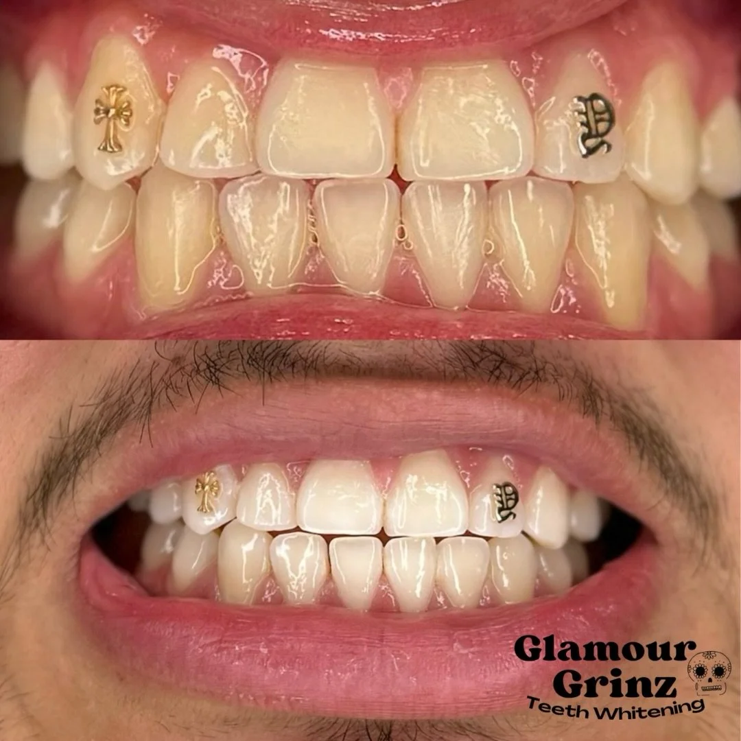 A brighter smile changes EVERYTHING 🤩✨

Look at this transformation 👀🦷

Nothing hits like fresh whitening + custom 18K gold charms 💎

✨ 18K charms available by request
✨ Crosses, letters, numbers + more
✨ Starting at $100

Ready for your glow up?
