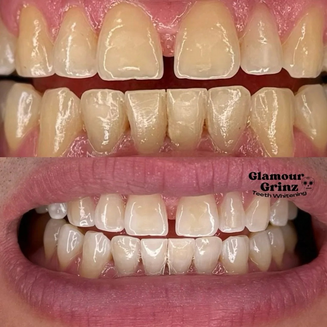 What a difference whitening can make! 🤩✨ 
these results are after 2 whitening sessions;

- When staining is deeper or has built up over time, multiple sessions are recommended to achieve the brightest results possible. 

- Every smile is different, 