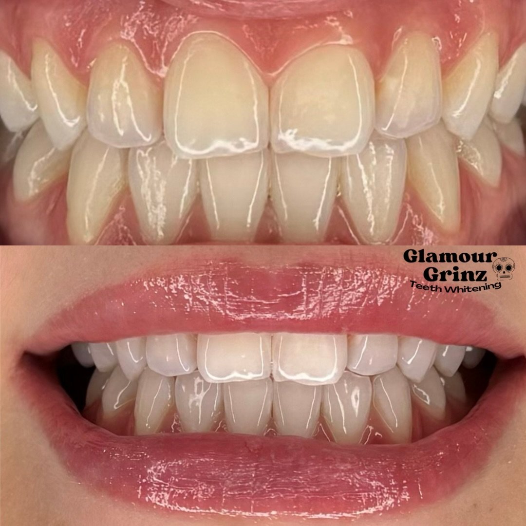 Beautiful smile 👏🏼🦷

Let&rsquo;s make yours&rsquo; glow next ! 

✨ book link in bio ✨
📍 Green Bay, WI 

-
-

#greenbay #greenbaywi #teethwhitening 
#wisconsin #beforeandafter