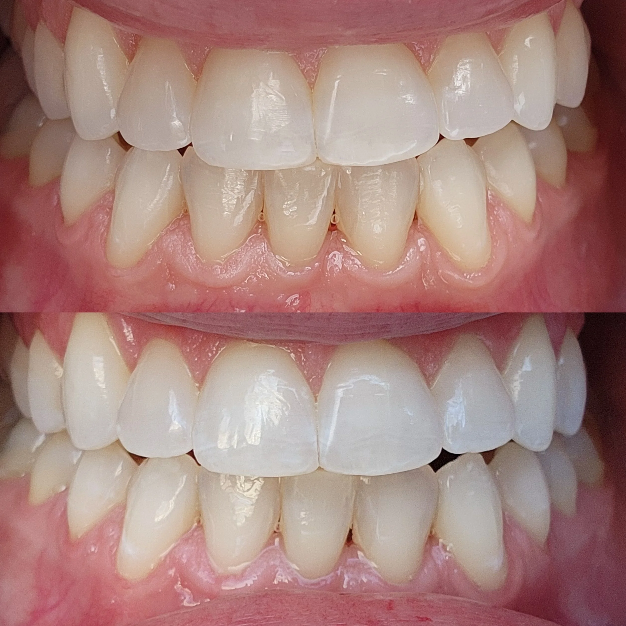 Close-up of a person's teeth showing before and after a 20 minute teeth whitening treatment at Bronze Couture in Kalamazoo, Michigan spray tanning and teeth whitening.