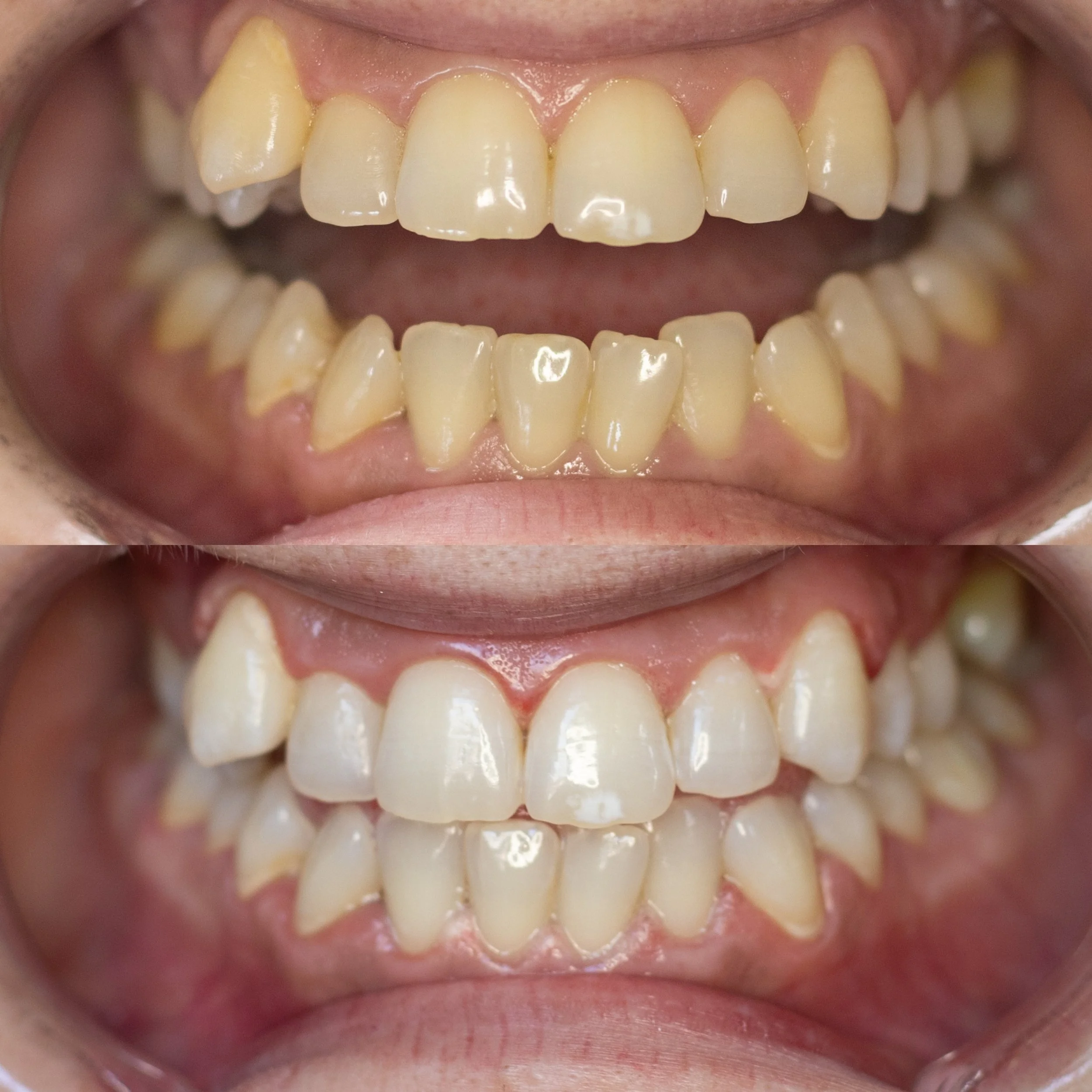 Close-up of a person's teeth showing before and after a 40 minute teeth whitening treatment at Bronze Couture in Kalamazoo, Michigan spray tanning and teeth whitening.