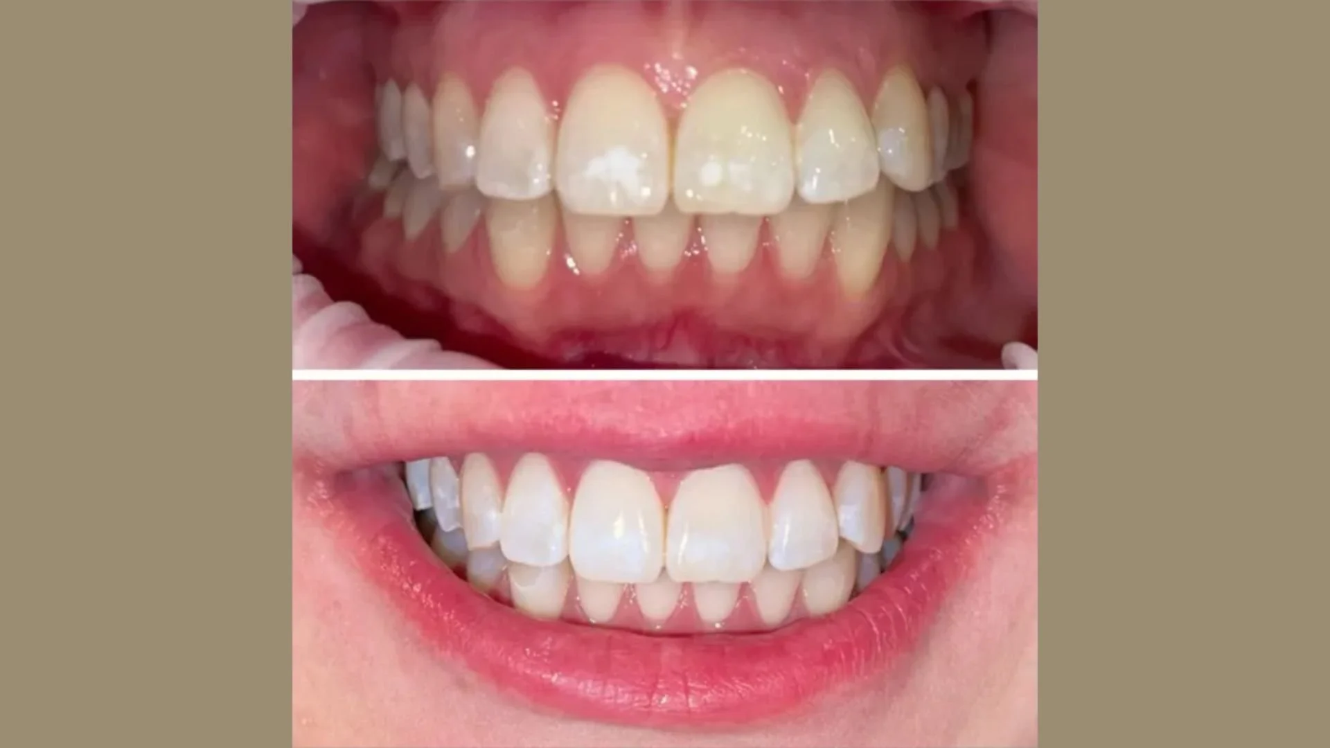 Comparison of teeth before and after whitening treatment, with the top showing yellowish teeth and the bottom showing brighter, whiter teeth at Bronze Couture in Kalamazoo, Michigan spray tanning and teeth whitening.