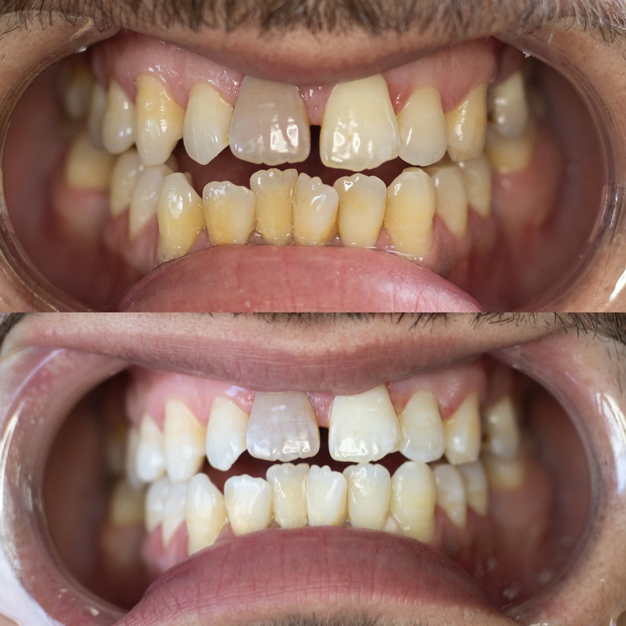 Close-up of a person's teeth showing before and after a 60 minute teeth whitening treatment at Bronze Couture in Kalamazoo, Michigan spray tanning and teeth whitening.