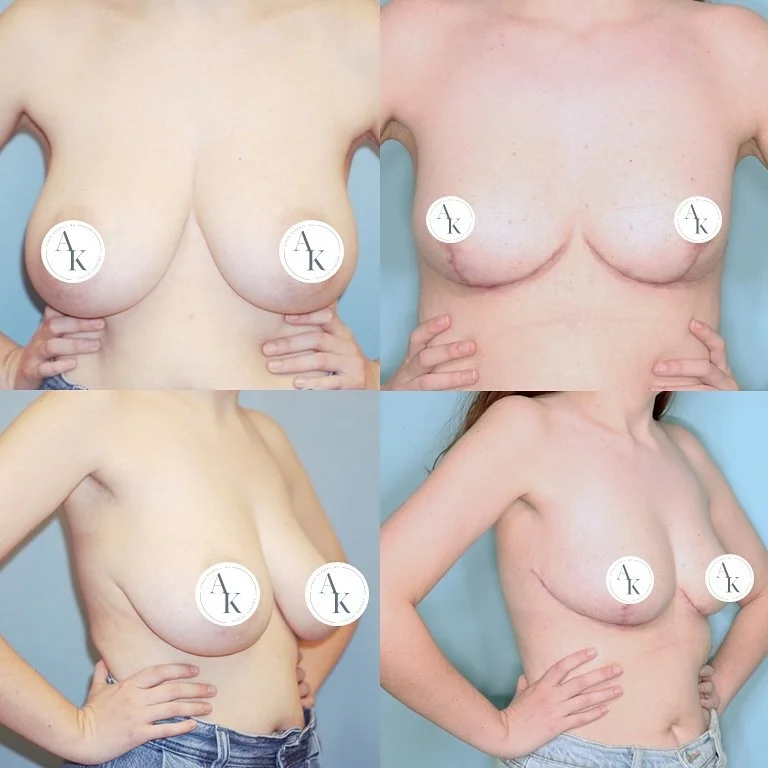 This lovely patient dealt with several years of back, neck and shoulder pain from her large breasts. She underwent a breast reduction and is feeling much better! 3 month postop result is shown. Her scars will continue to fade over the next several mo