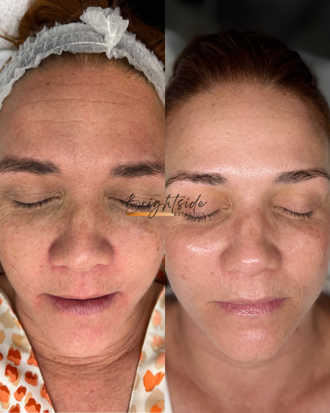 Brightside Esthetics in Huntington Beach Anti-Aging Treatments Before and After