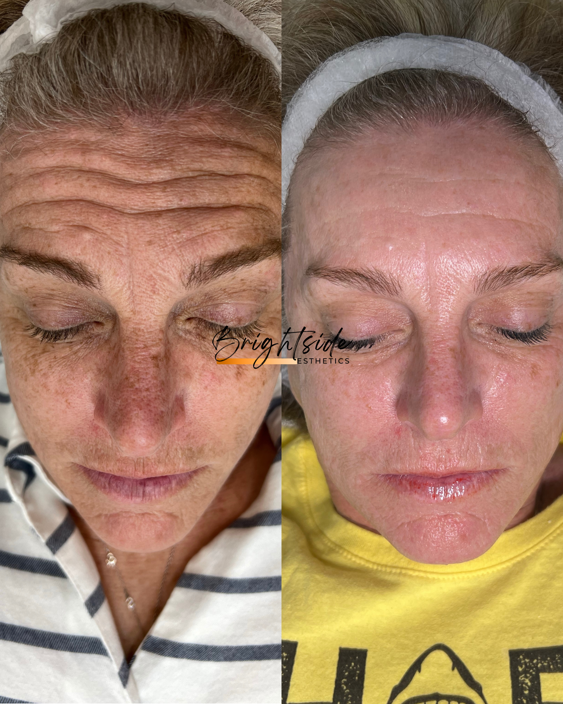 Brightside Esthetics in Huntington Beach Sun Damage and Hyperpigmentation Treatments Before and After