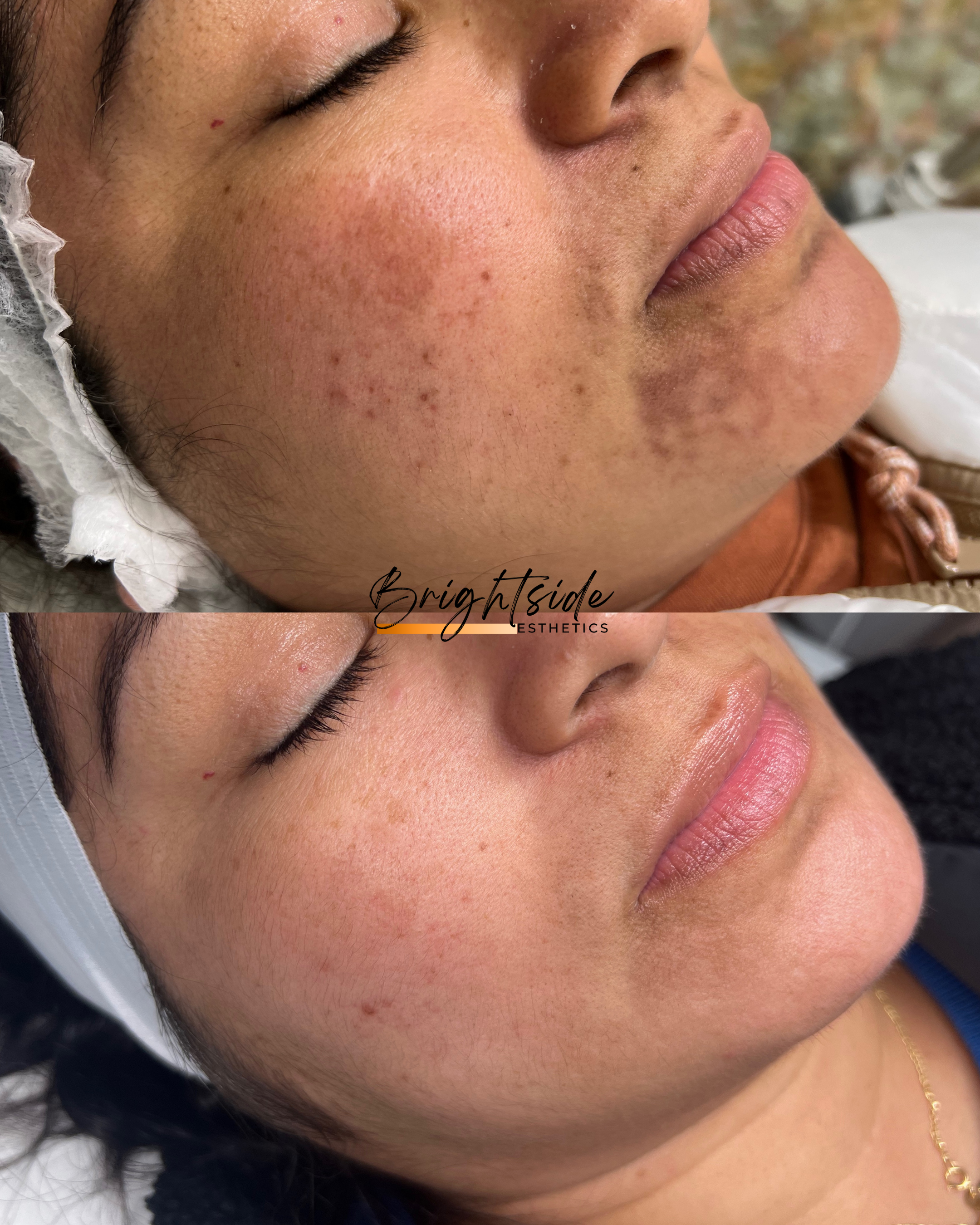 Brightside Esthetics in Huntington Beach Melasma Treatments Before and After
