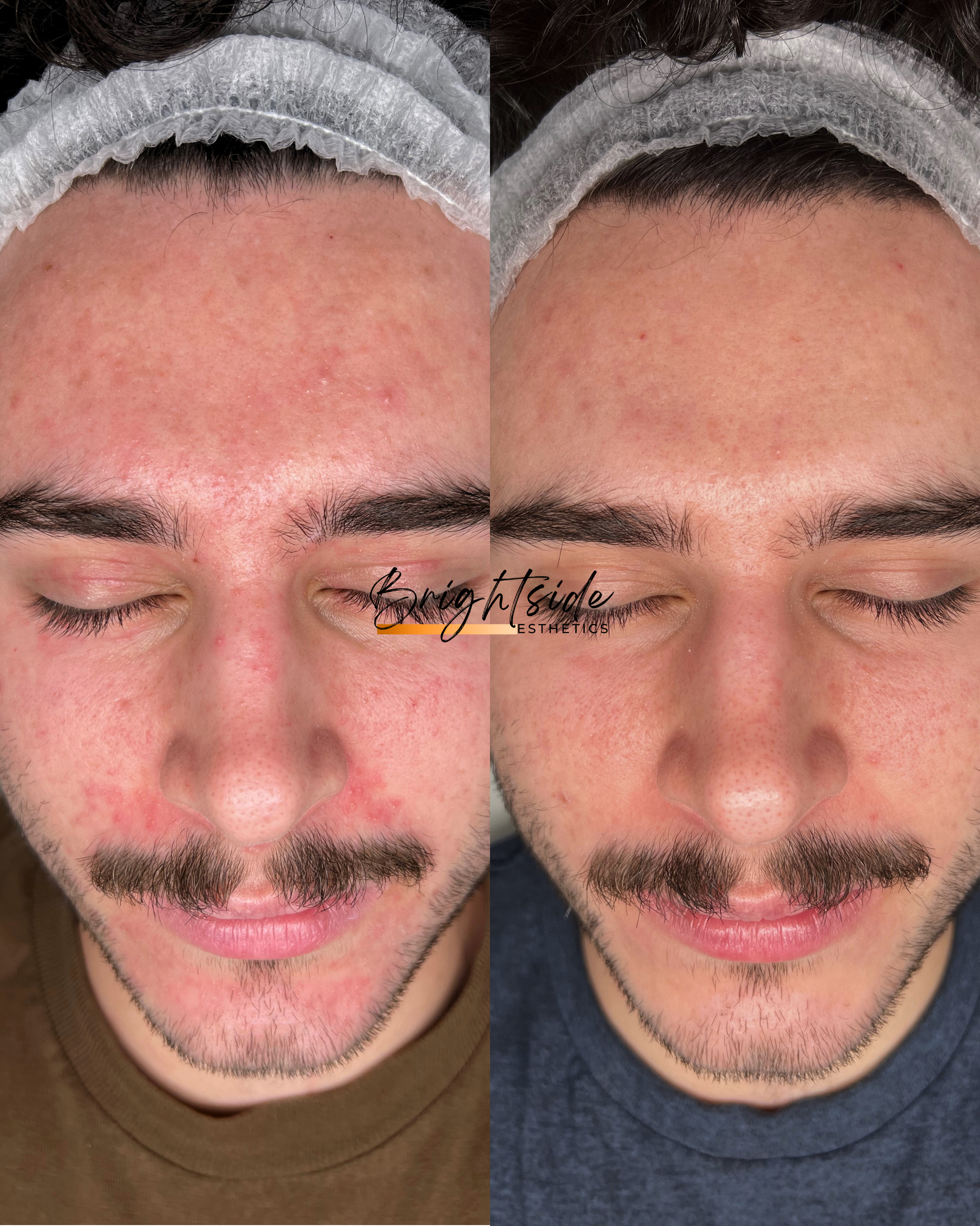 Brightside Esthetics in Huntington Beach Inflamed and Sensitive Skin Treatments Before and After
