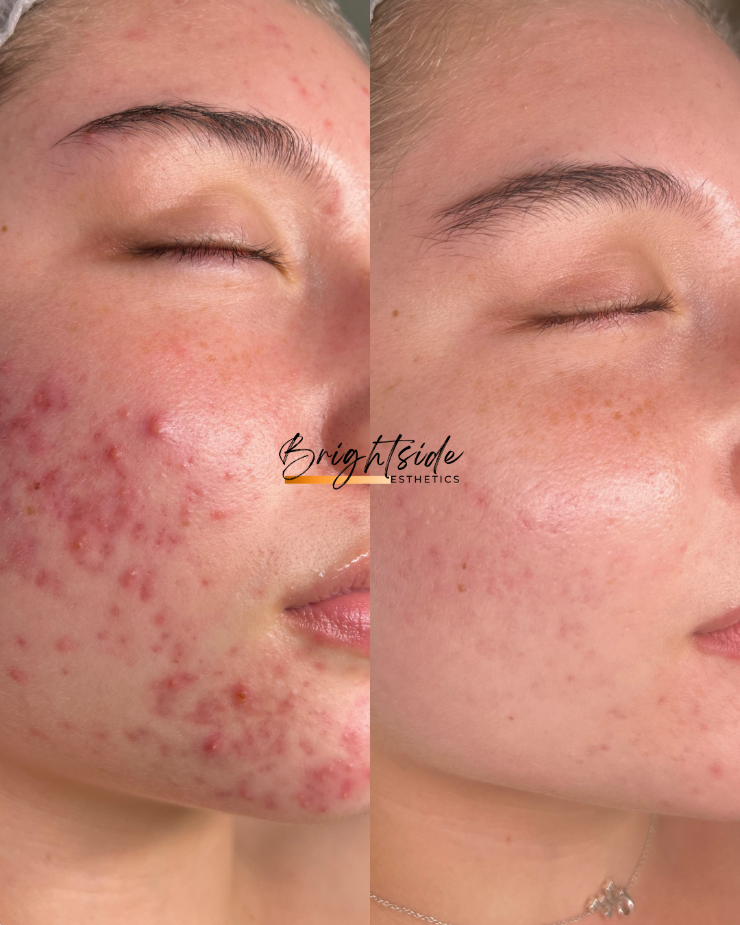 Brightside Esthetics in Huntington Beach Acne and Acne Scar Treatments Before and After