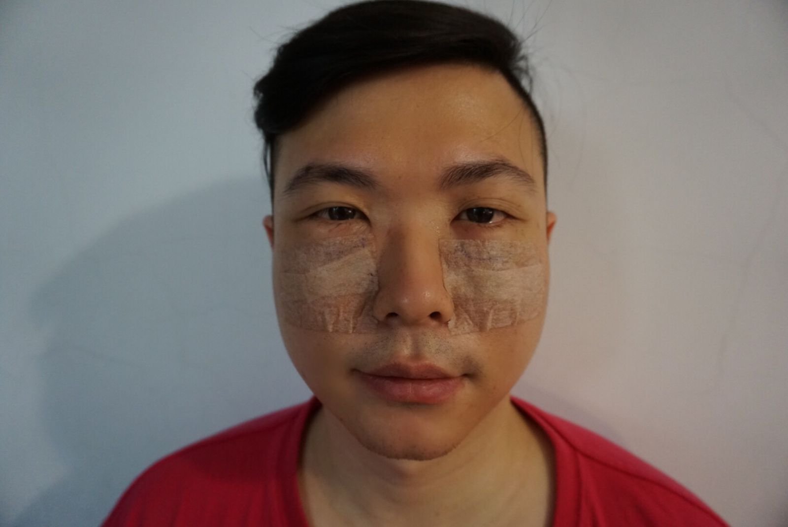 DAY 2 術後拆線