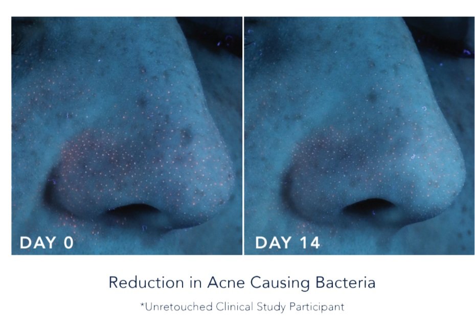 Prelude+Acne+Reduction.jpg