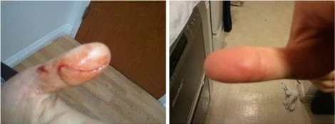 Finger Laceration
Patient : Female Main Problem : FINGER LACERATION Treatment : Total 10 times
Before and after photo