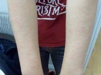 Skin Problem 
Patient : Female Main Problem : SKIN PROBLEM Treatment : Total 10 times / Herb 1 set
Before Photo