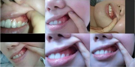 Patient : Female Main Problem : MOUTH ULCER Treatment : 2 or 3 times/week Treatment duration 2 weeks
Before and after photos