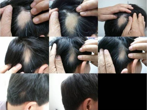 Hair Loss Case 
Patient : Male
Main Problem : HAIR LOSS
Treatment : 1 or 2 times/week and Herb formula 2 sets
Before and after photos