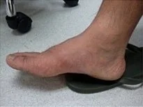 Gout Patient : Male Main Problem : GOUT Treatment : Total 10 times / Herb 1 set
After Photo