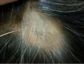 Hair Loss 03
Patient : Male Main Problem : HAIR LOSS Treatment : 2/25/12 ~ 4/14/12 1 time / 1 or 2 weeks 
Progress photo