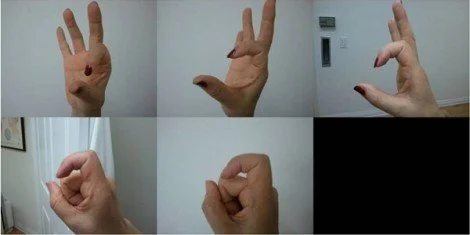 Bending & Pain
Patient : Female
Main Problem : FINGER BENDING & PAIN
Dog bit her finger after that pain and bending problem for 4 months before she start treatment
Treatment : Total 9 times and Herb formula 1 set
Before and after photos