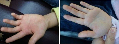 Hand palm Eczema
Patient : Female Main Problem : ECZEMA Treatment : – Herb formula 1 set
Before and after