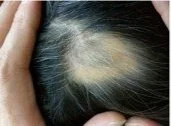 Hair Loss 03
Patient : Male Main Problem : HAIR LOSS Treatment : 2/25/12 ~ 4/14/12 1 time / 1 or 2 weeks 
After photo stopped coming for treatment