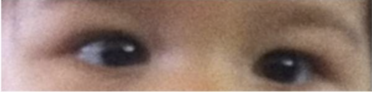 Cross-eyed Patient : Male(1 year-old) Main Problem : CROSS-EYED Treatment : Total 3 times
Before Picture