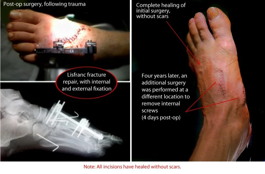 A collage showing post-op images of a Lisfranc fracture on a foot. Top left: Foot with external fixation device post-surgery. Bottom left: X-ray of foot with internal screws. Right: Foot after healing and subsequent screw removal surgery, with visible scars.