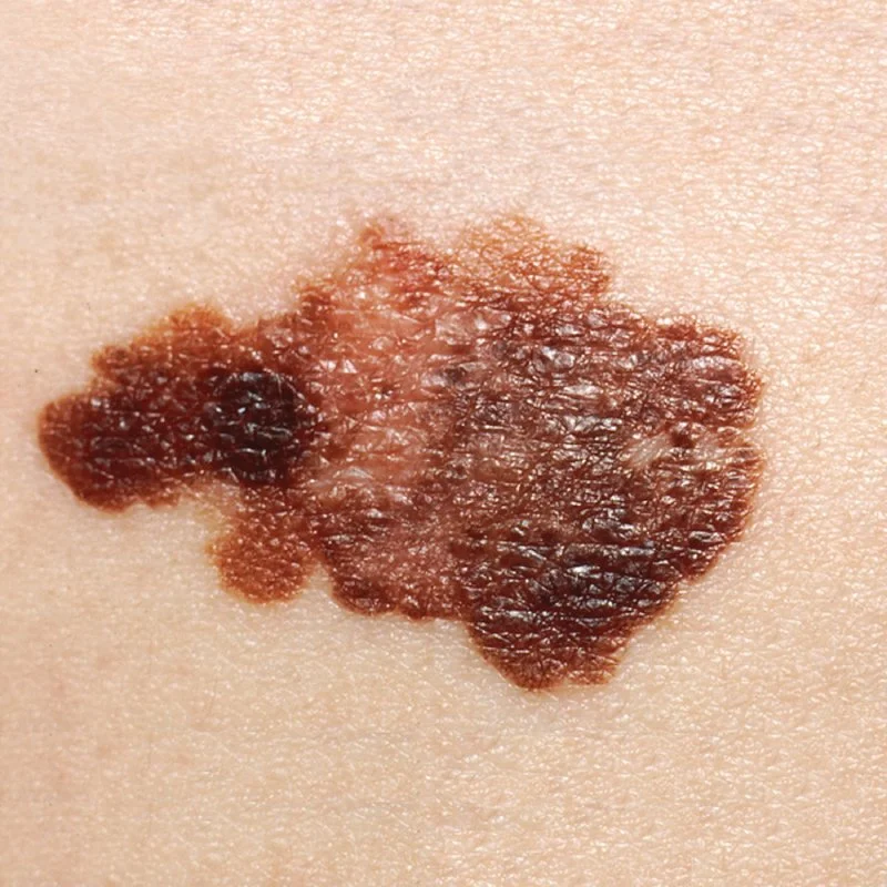 Melanoma.jpeg