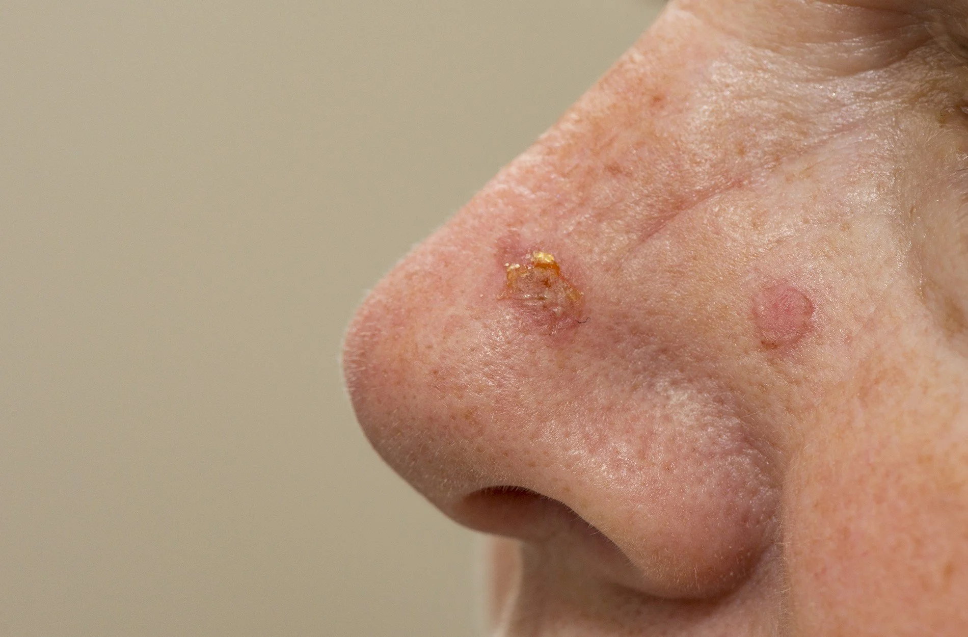 Basal cell and squamous cell skin cancers.jpg