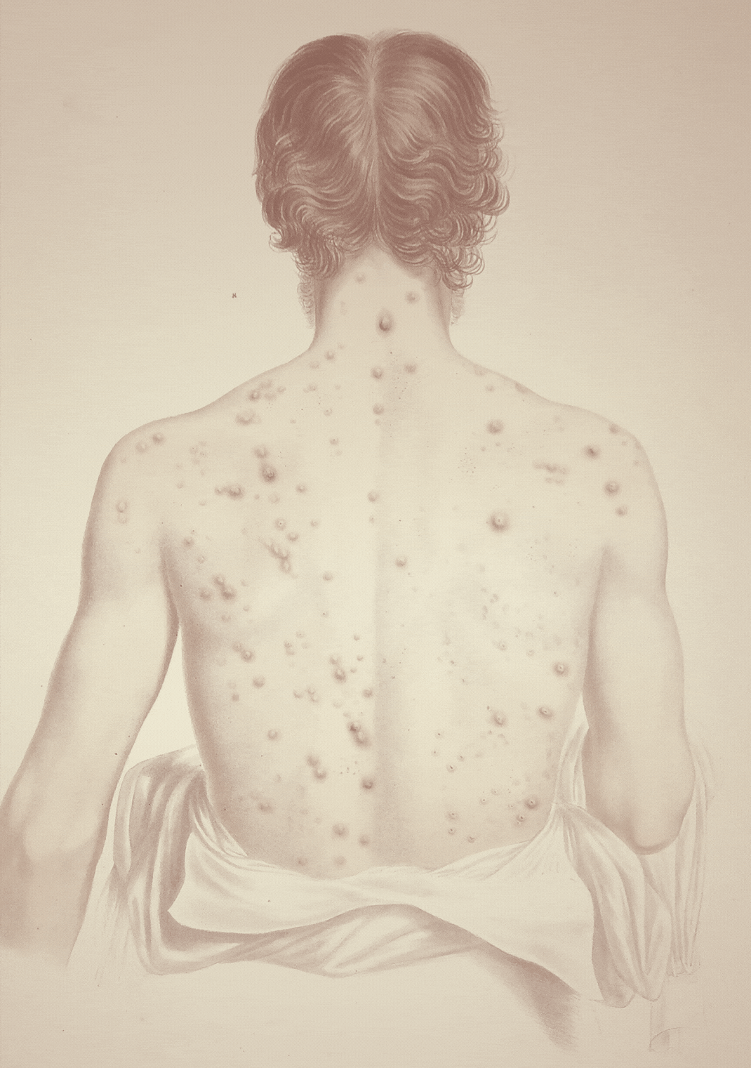 Favus Rash Rash Decisions Dermatology