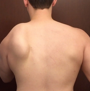 Serratus Anterior