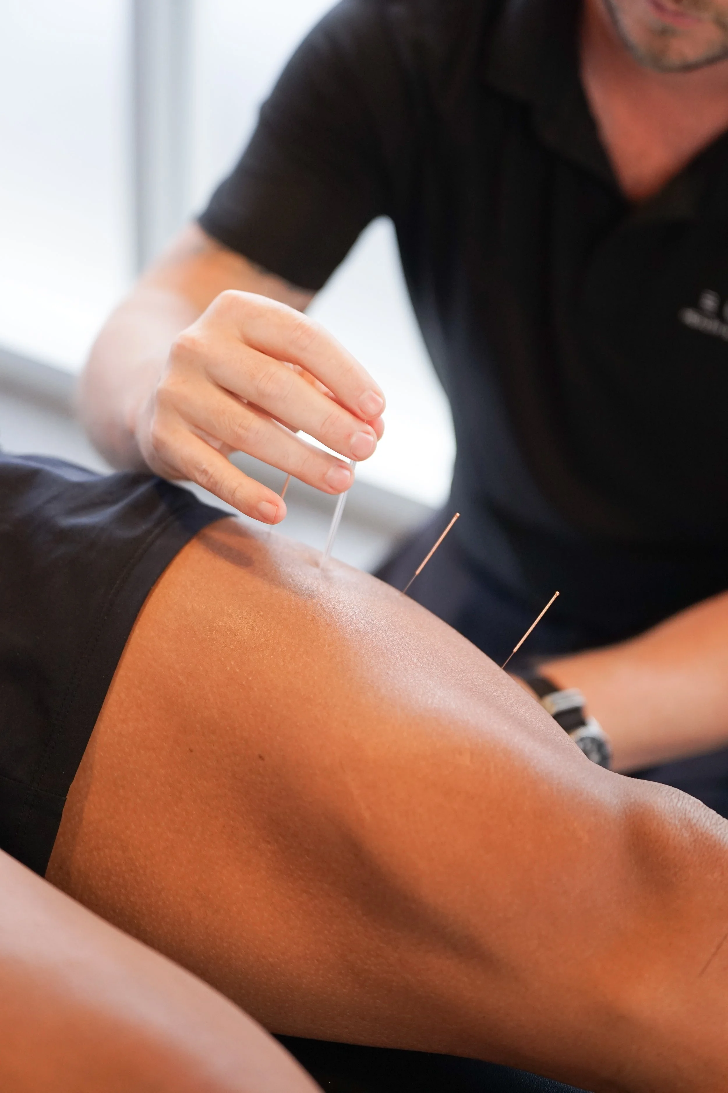 ✅ Dry needling treatment targeting muscle tension