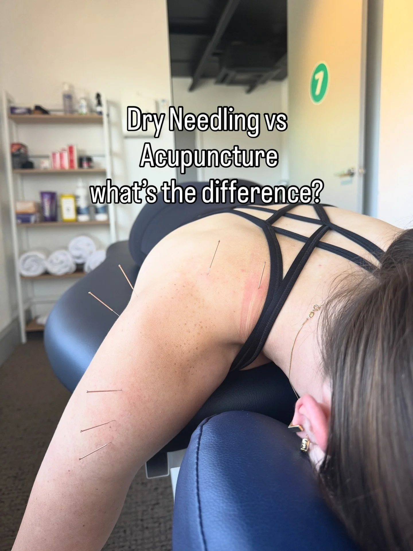 Dry needling and acupuncture often look similar from the outside, but they come from very different clinical frameworks.

Acupuncture is rooted in Traditional Chinese Medicine and works by stimulating specific meridian points to influence the body&rs