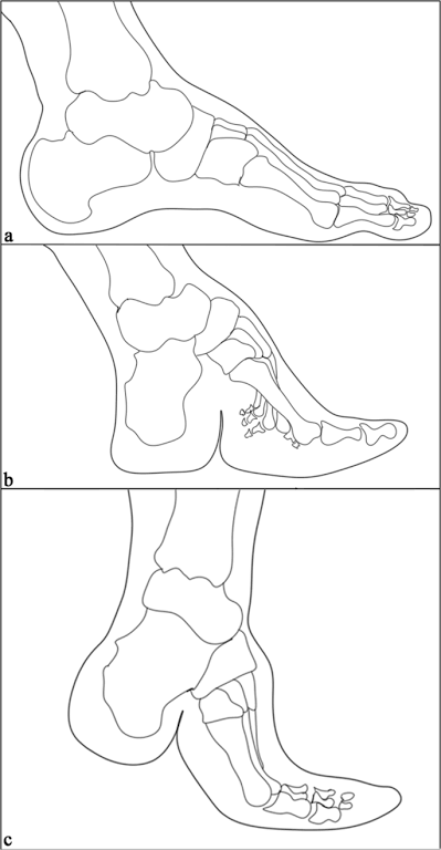 Line drawings of feet with the bone drawings included. Top image displays a normal foot. Middle image displays a fully bound foot. Bottom image displays a half-bound foot.