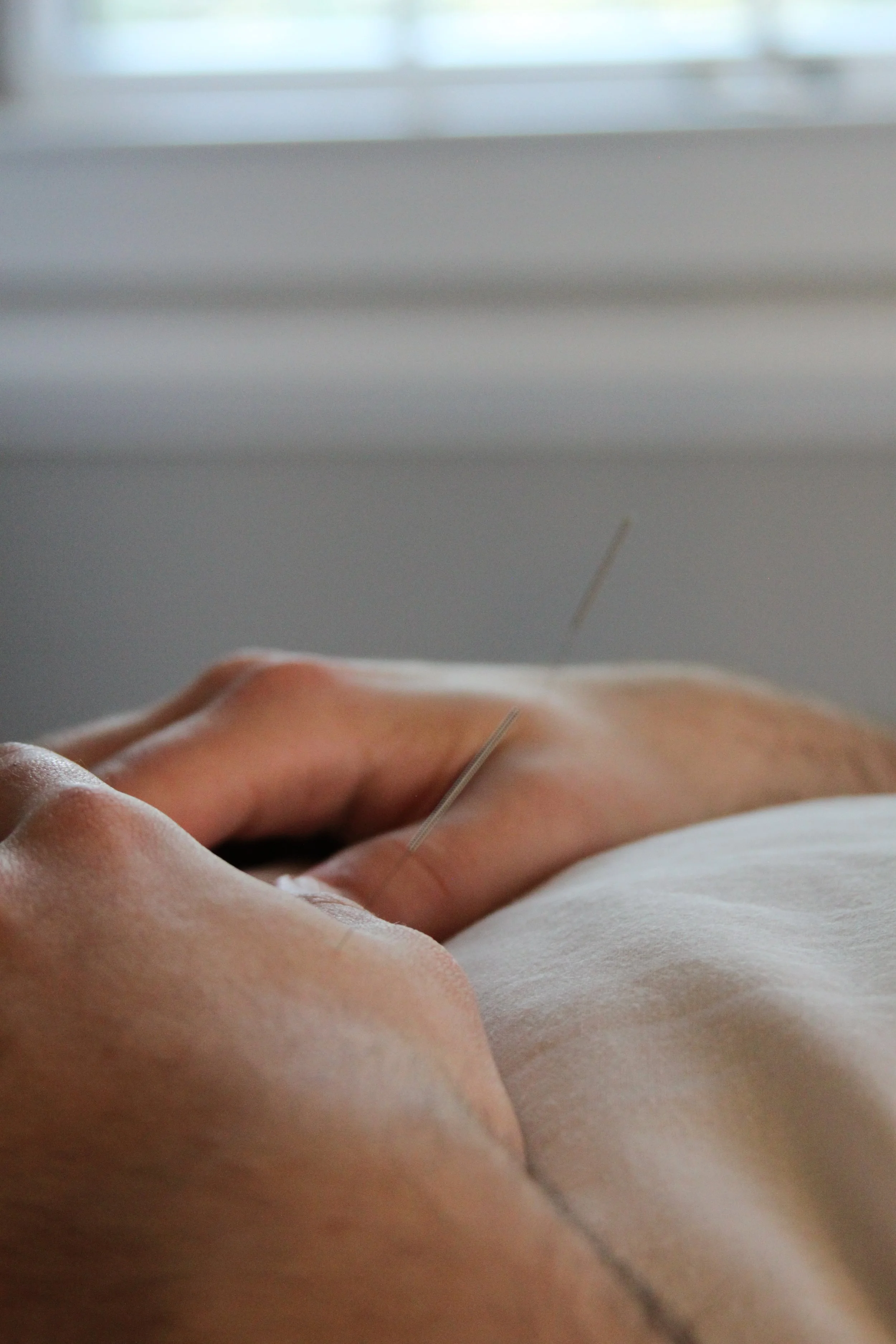 Acupuncture treatment in Charleston SC