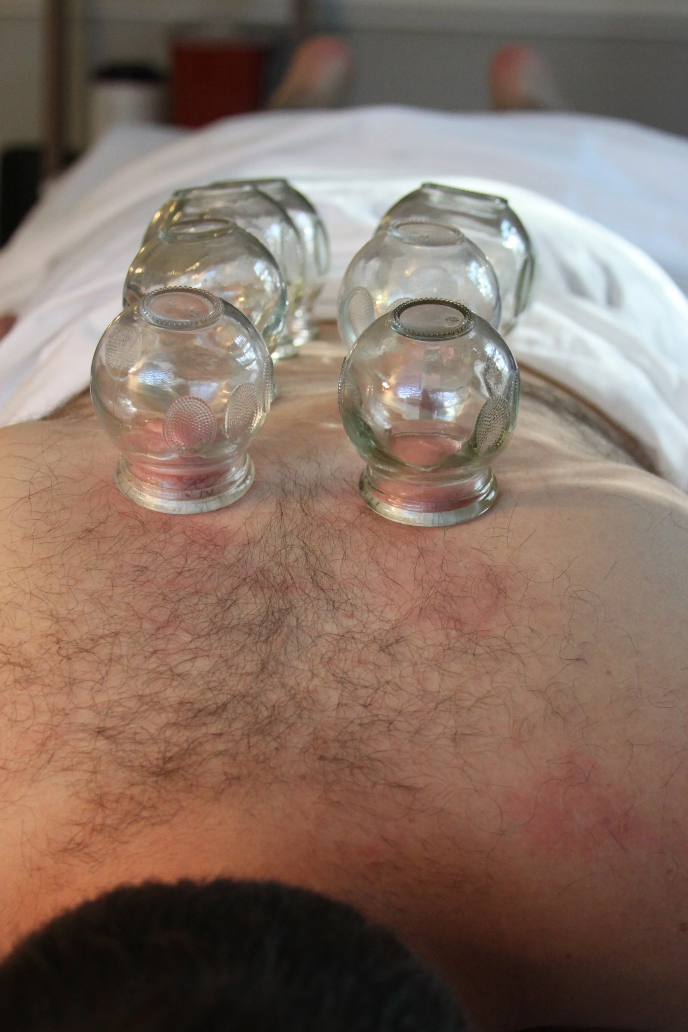 Cupping therapy in mt pleasant and Charleston SC