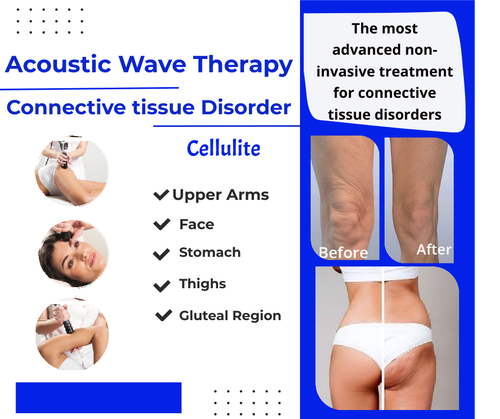 Acoustic Wave Therapy advertisement highlighting cellulite treatment areas such as upper arms, face, stomach, thighs, and gluteal region. Features before and after photos and describes it as a non-invasive connective tissue disorder treatment.