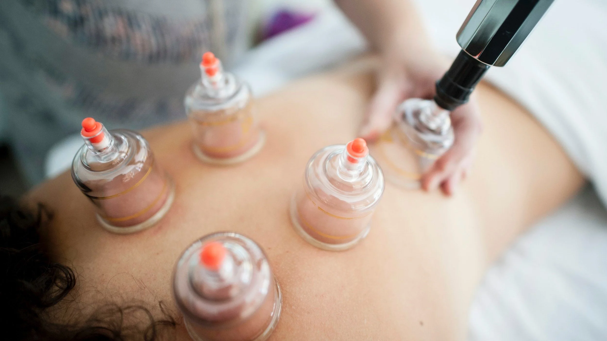 Cupping therapy on a person's back with multiple suction cups.