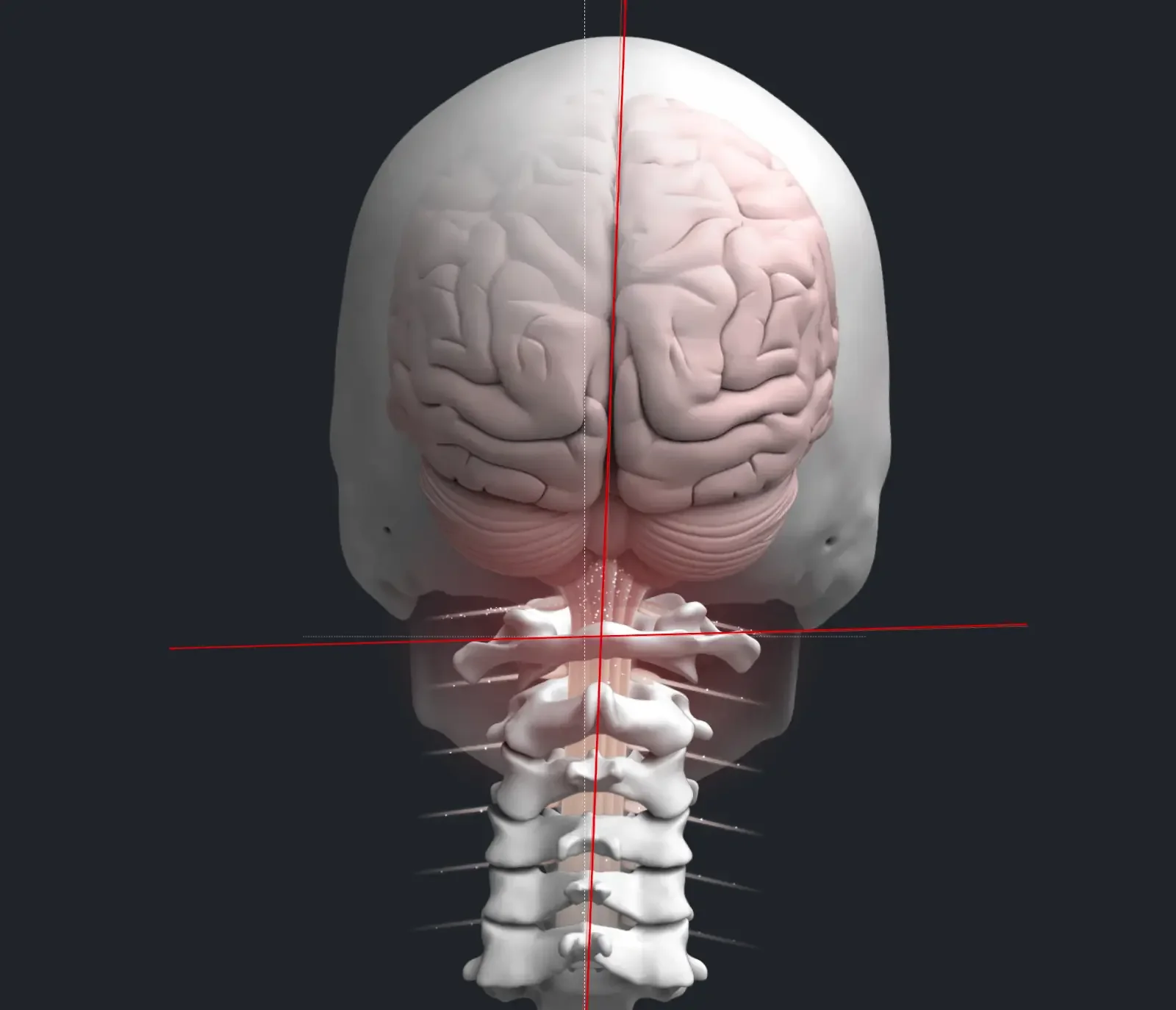 Misaligned Spine Fixed with Atlas Orthogonal
