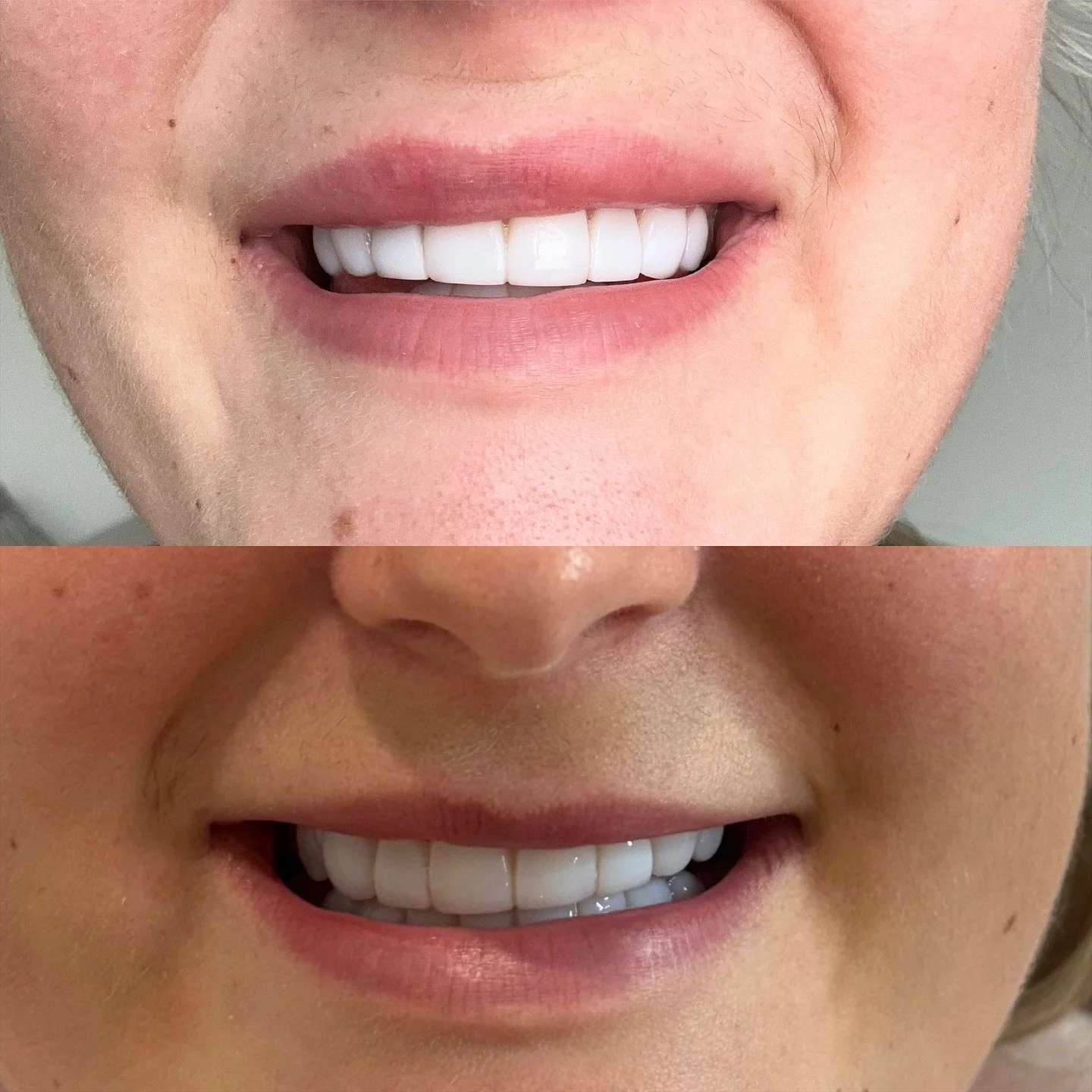 𝐋𝐈𝐏 𝐅𝐋𝐈𝐏 
Looking for a natural enhancement to your lips without filler? 
Anti-Wrinkle Treatment used to flip your lip out when it tucks under when you smile, we can also use this treatment to even out your smile! 😁 
Price: £105
Locat