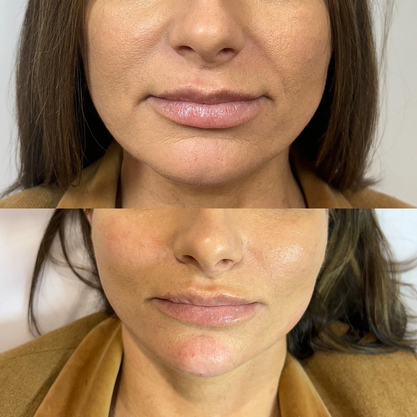 𝐅𝐀𝐂𝐈𝐀𝐋 𝐅𝐈𝐋𝐋𝐄𝐑 
3ml Filler used here to create this subtle change! 
As you can see adding volume to the jaw and adding filler to the chin to elongate we achieve these results! 💉
If you have any questions regarding any facial filler ple