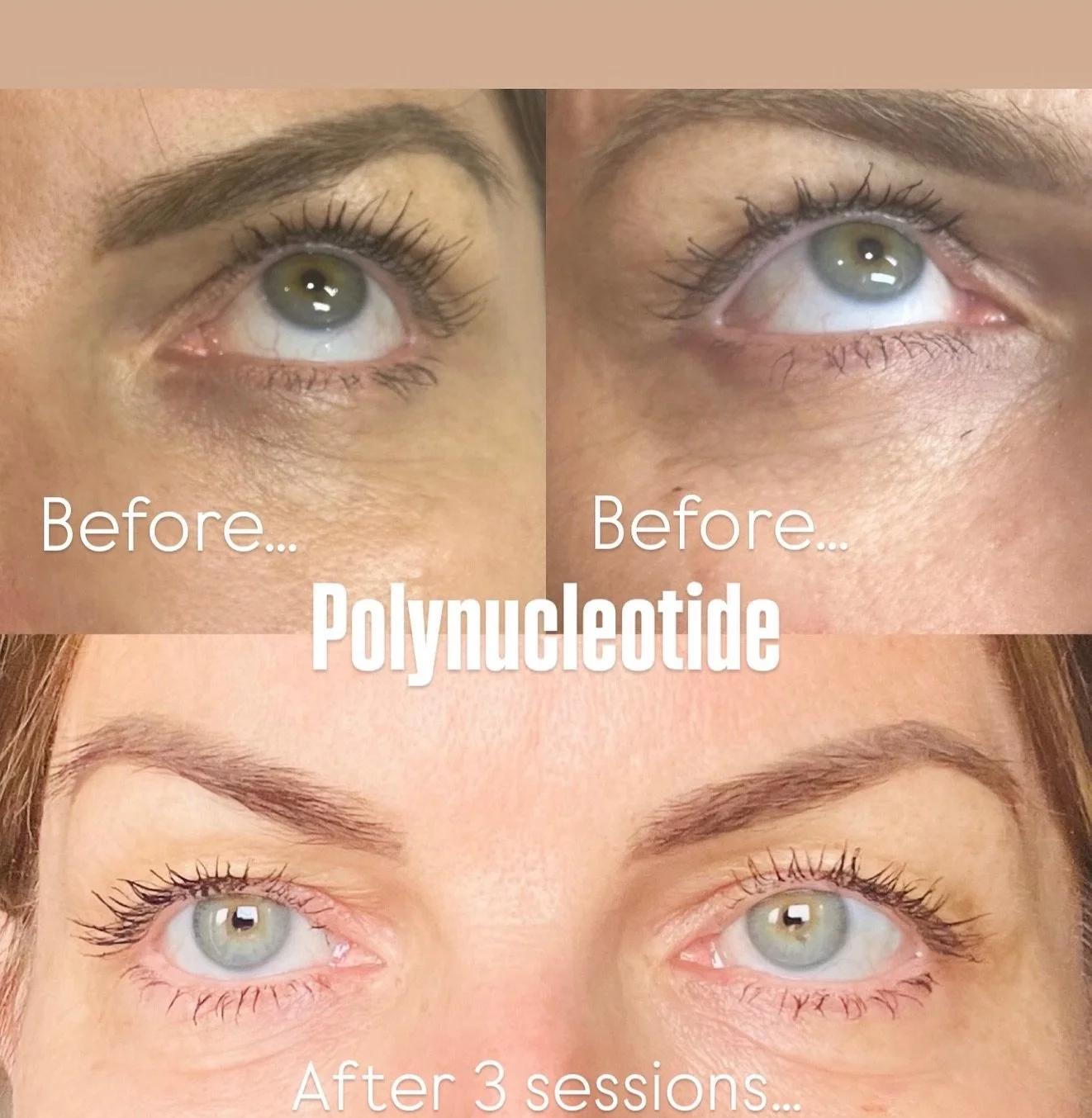 𝐏𝐎𝐋𝐘𝐍𝐔𝐂𝐋𝐄𝐎𝐓𝐈𝐃𝐄𝐒🧬
Amazing results for our polynucleotide treatment! This client has been looking for a solution for her under eyes for a while, until she met POLYNUCLEOTIDE 🧬 she has never been happier with her under eyes! 🤩 Our new