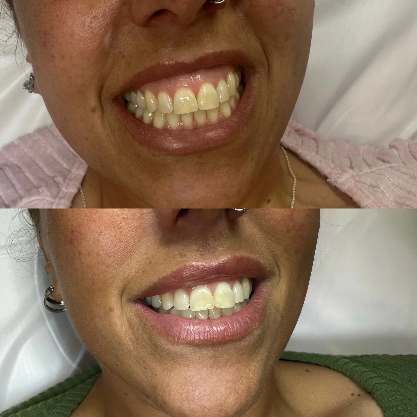 𝑮𝑼𝑴𝑴𝒀 𝑺𝑴𝑰𝑳𝑬
Does this look like a treatment that would benefit you? 
Please get in touch! We will be happy to assist! 😊
Gummy smile is a advanced treatment where only a few injections used to relax the muscle creating these results. 
⏰