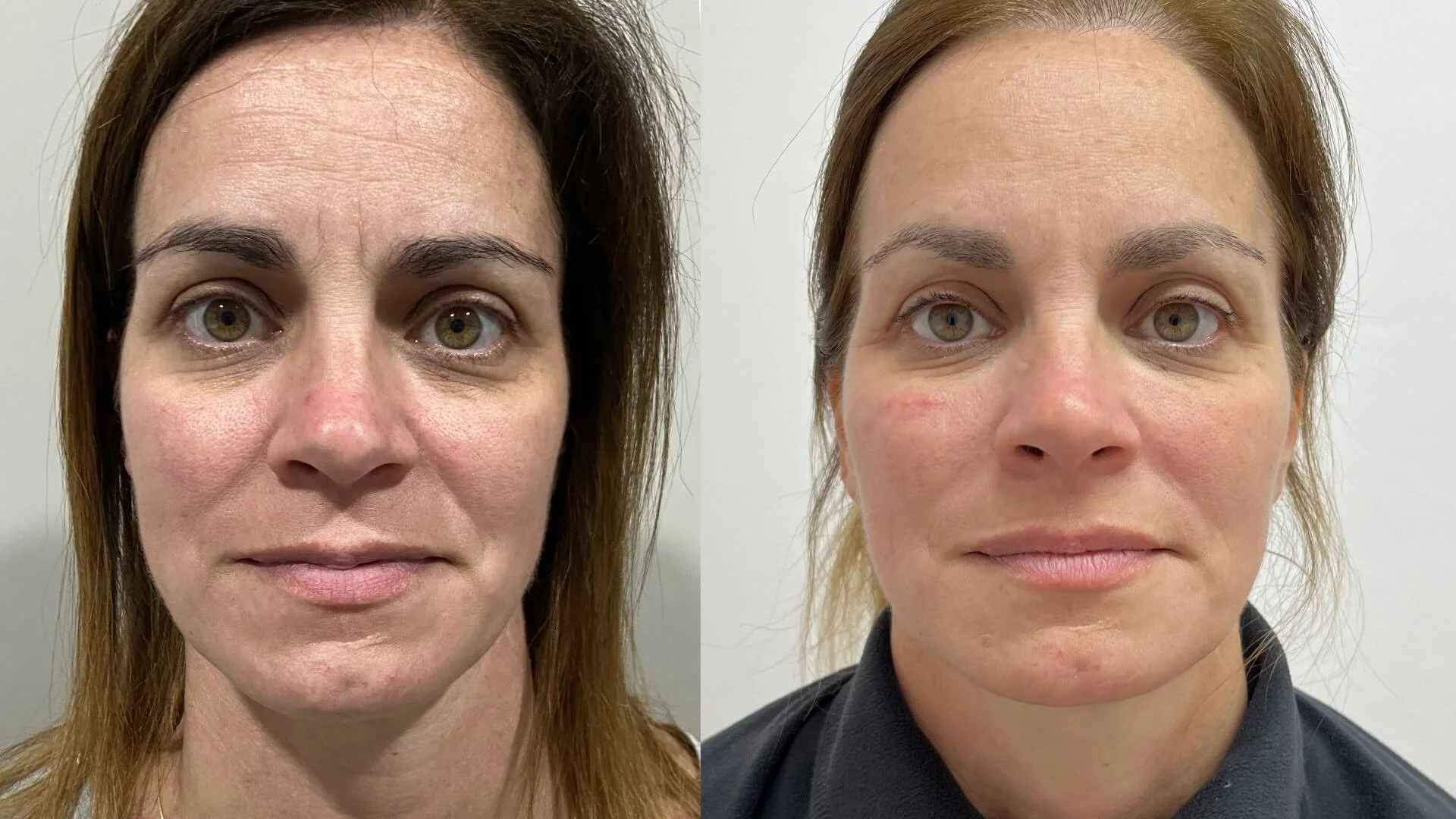 Before and after liquid facelift with fillers and Botox for 41-year-old patient NYC