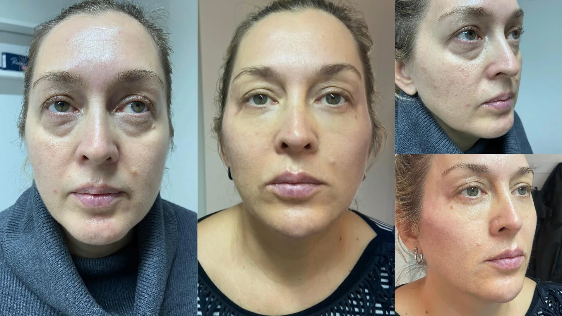 Before and after hyaluronic acid filler for under eye rejuvenation in NYC
