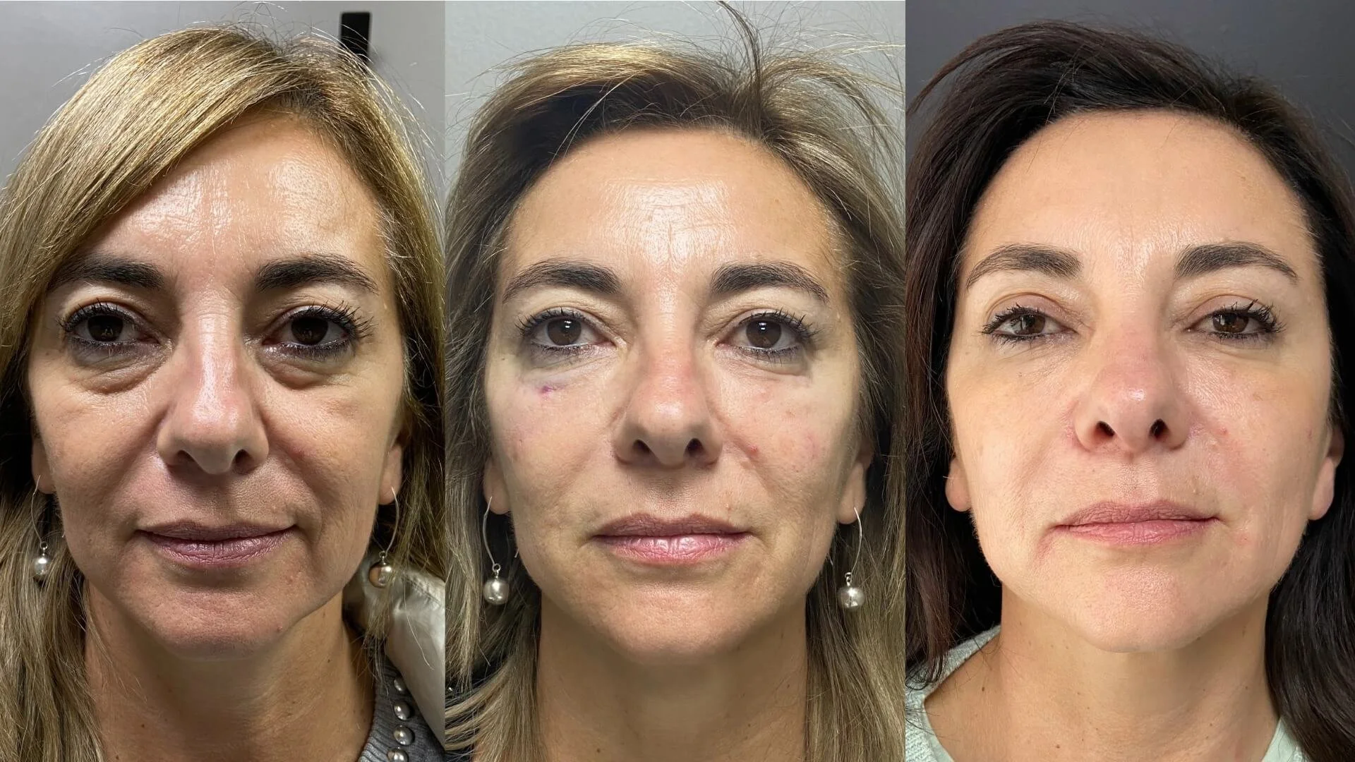 Before and after full face harmonization with fillers, 52-year-old patient, Upper East Side NYC