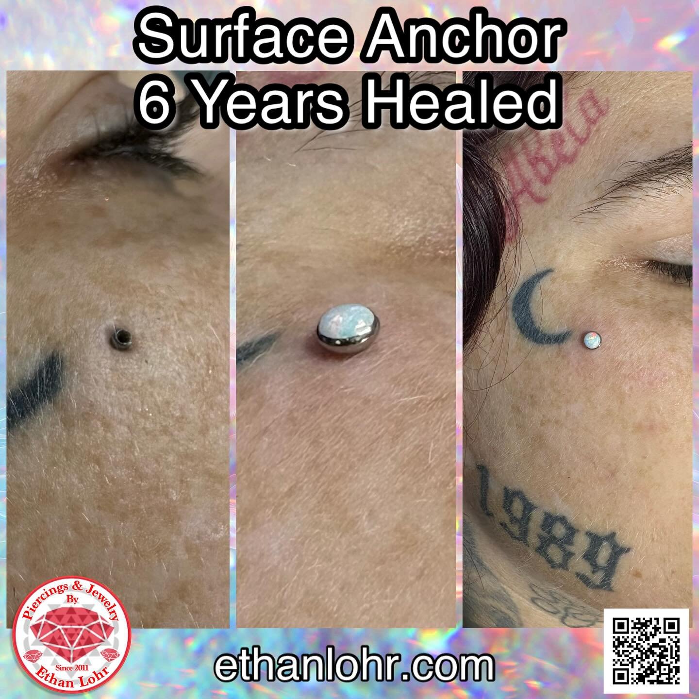 Done in 2019 ☺️ healed perfectly.
https://www.ethanlohr.com/faq
