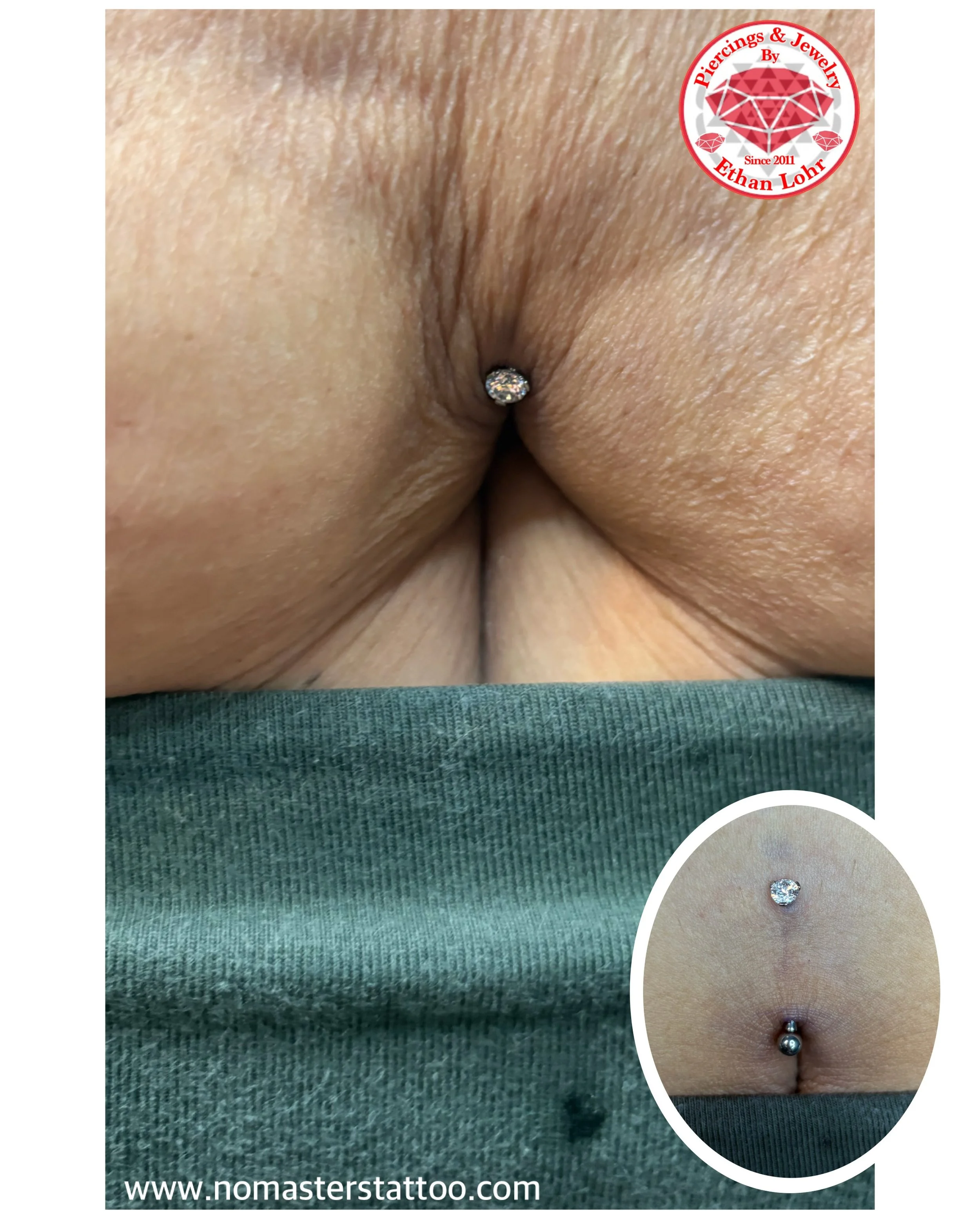 Navels are very anatomy dependent. Size is not the determining factor; the shape and way it maneuvers when sitting and laying are more of what we make decisions based on. Sometimes we can offer what&rsquo;s called a floating navel rather than the tra