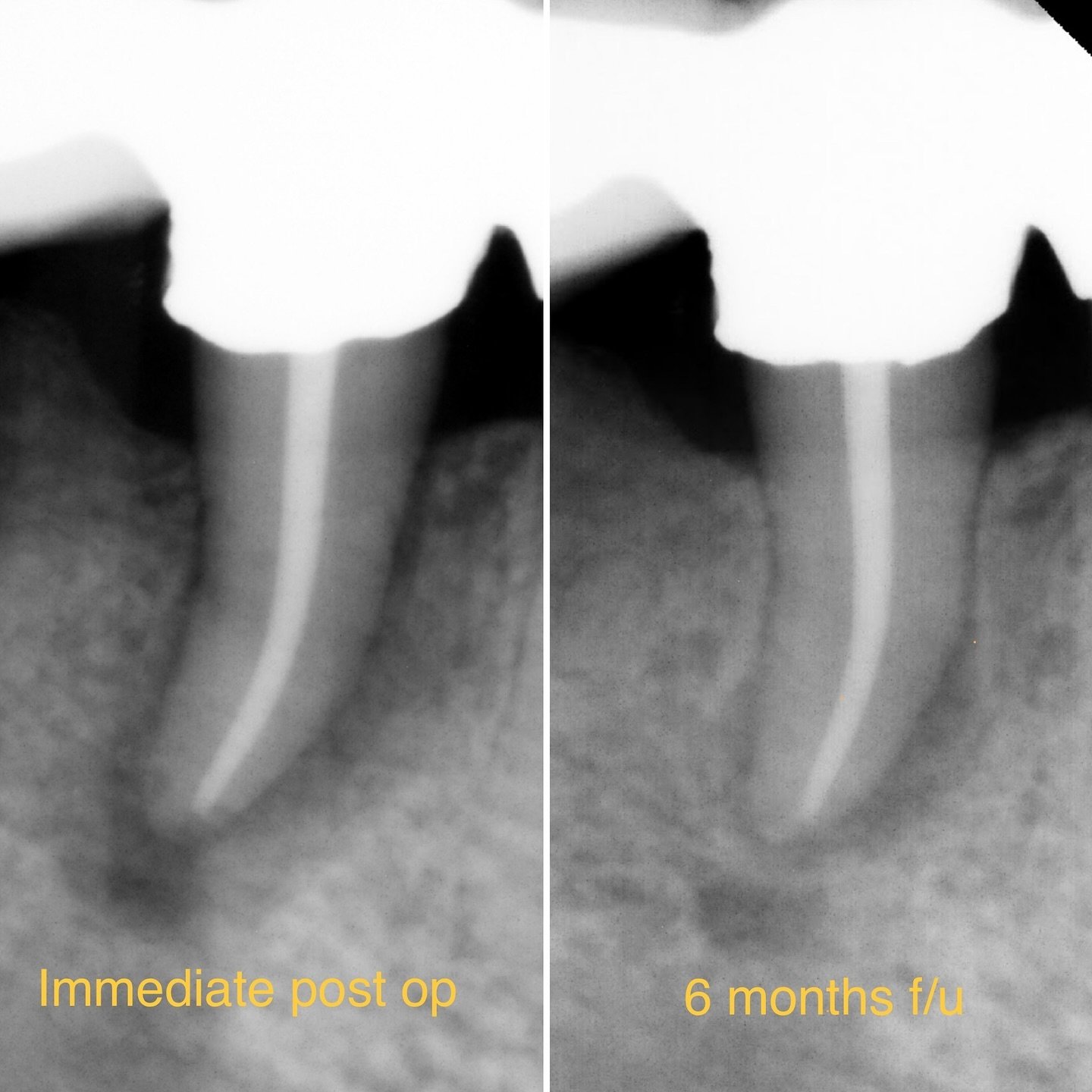 I like to be wrong sometimes!! I was very pessimistic about the future of this tooth since it was heavily perio involved but we wanted to save it since it&rsquo;s part of a long bridge. Low and behold the 6 mos follow-up 🤩
