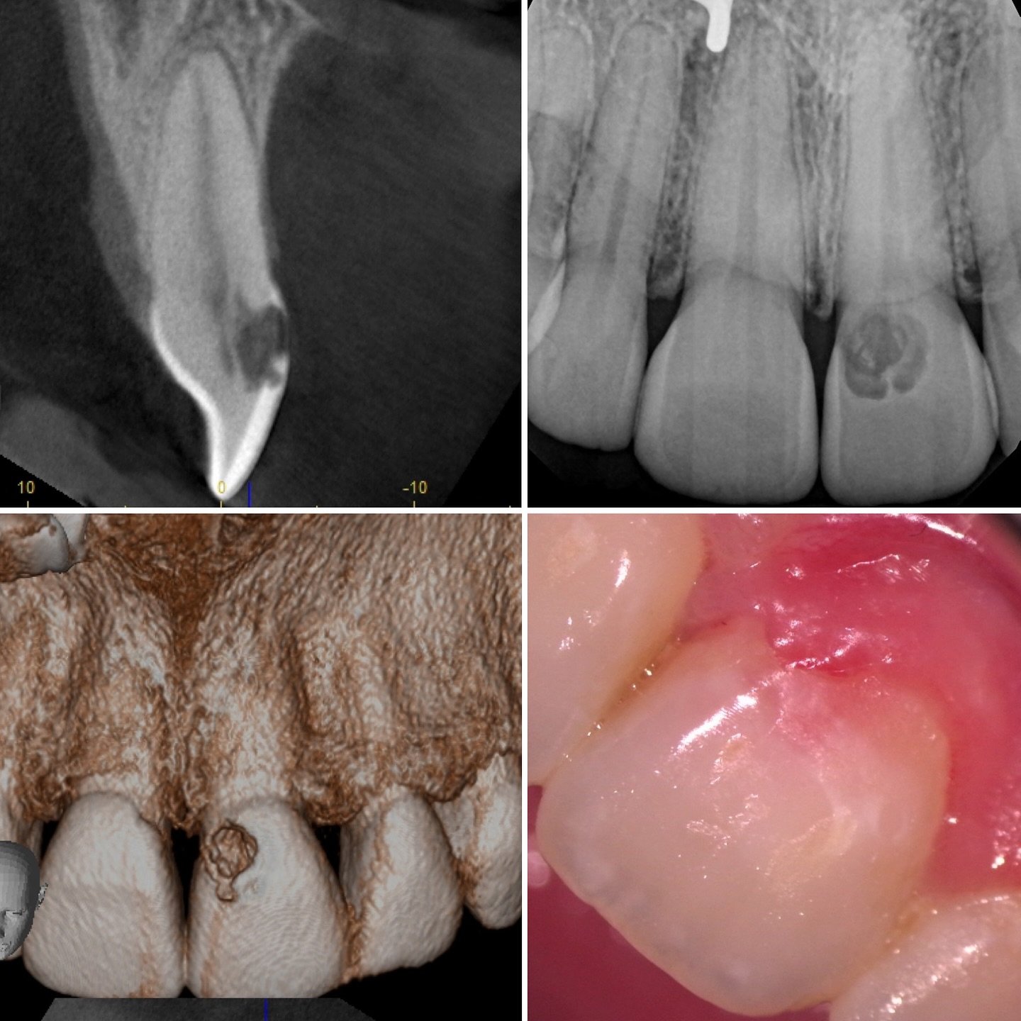 Classic Pink Tooth 🦷 
External resorption management with labial access for the root canal treatment saving the palatal tooth structure. The patient started developing symptoms and we were able to catch this lesion early&hellip; which allowed placem